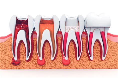 dente mal desvitalizado sintomas 